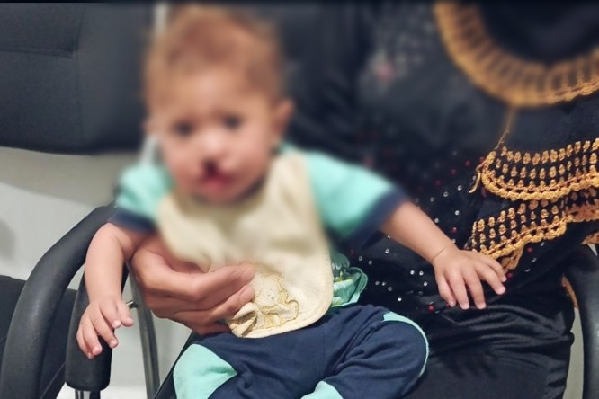 طفل عمره سنة وُلد بشفة أرنب وسقف حلق مفتوح ويُعاني من فتاق في الحالب بحاجة عملية بأقصى سرعة