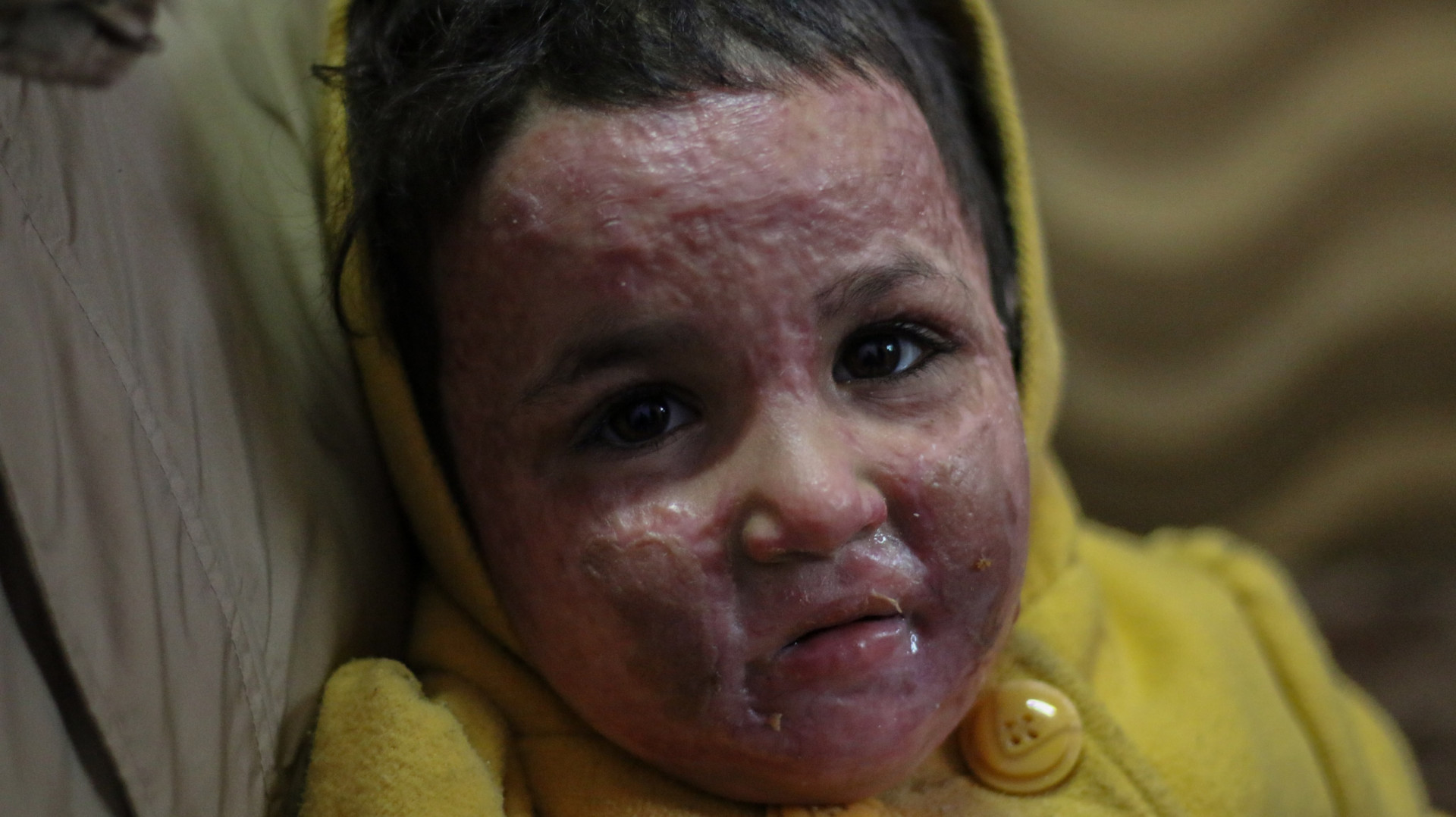 A girl child with sever burns