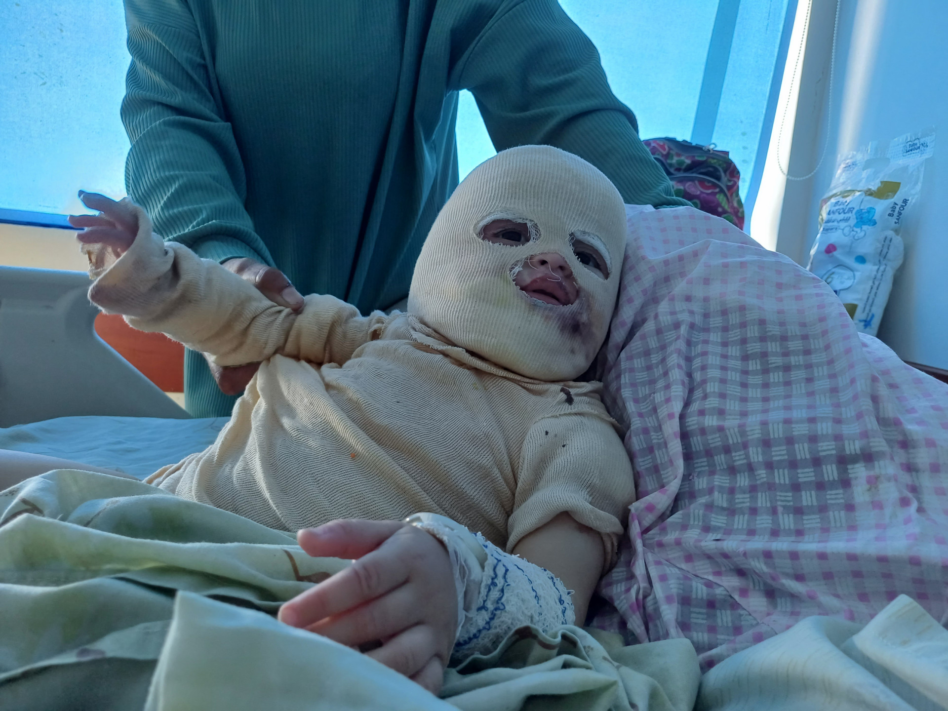 A Chance to Save a Child from the Pain of Burns