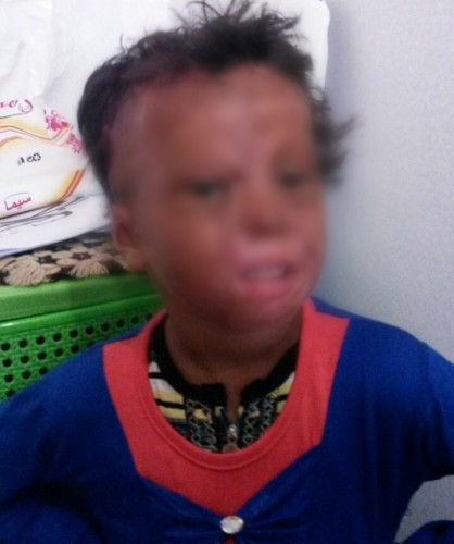 female kid infected with serious burns