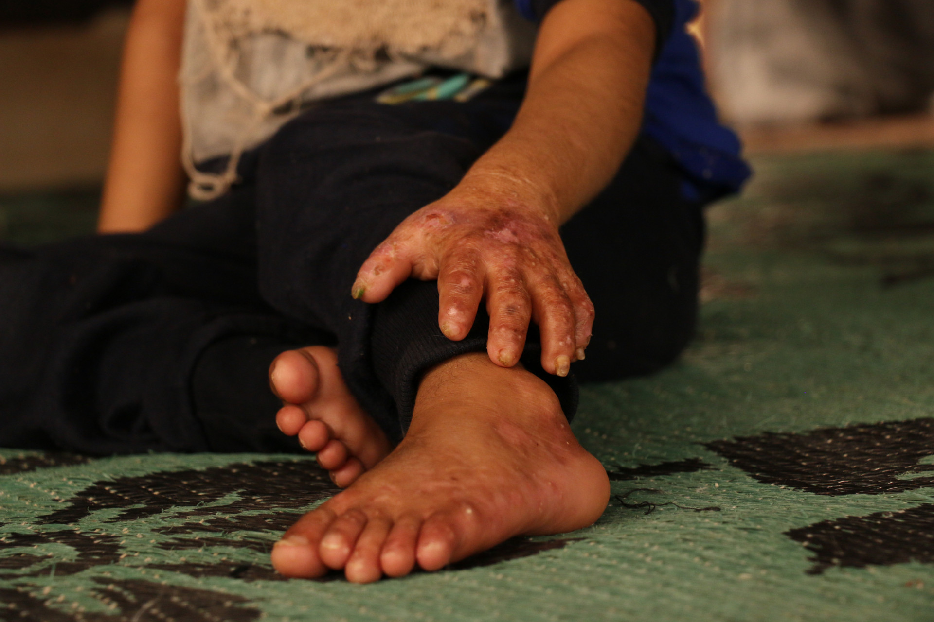 A 7-years-old suffering from Pemphigus