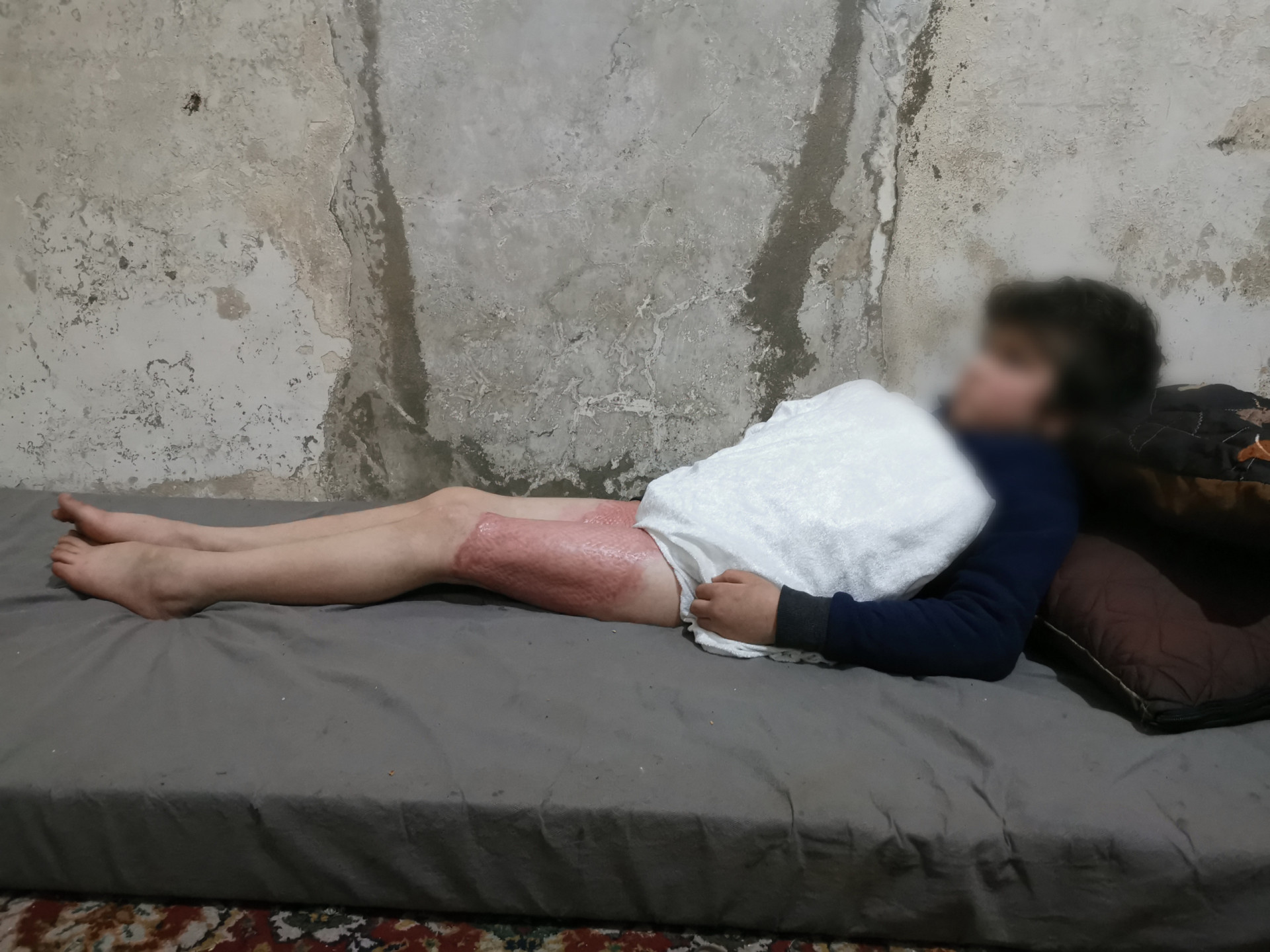 Abdullah was injured by severe burns... Now he needs your help.