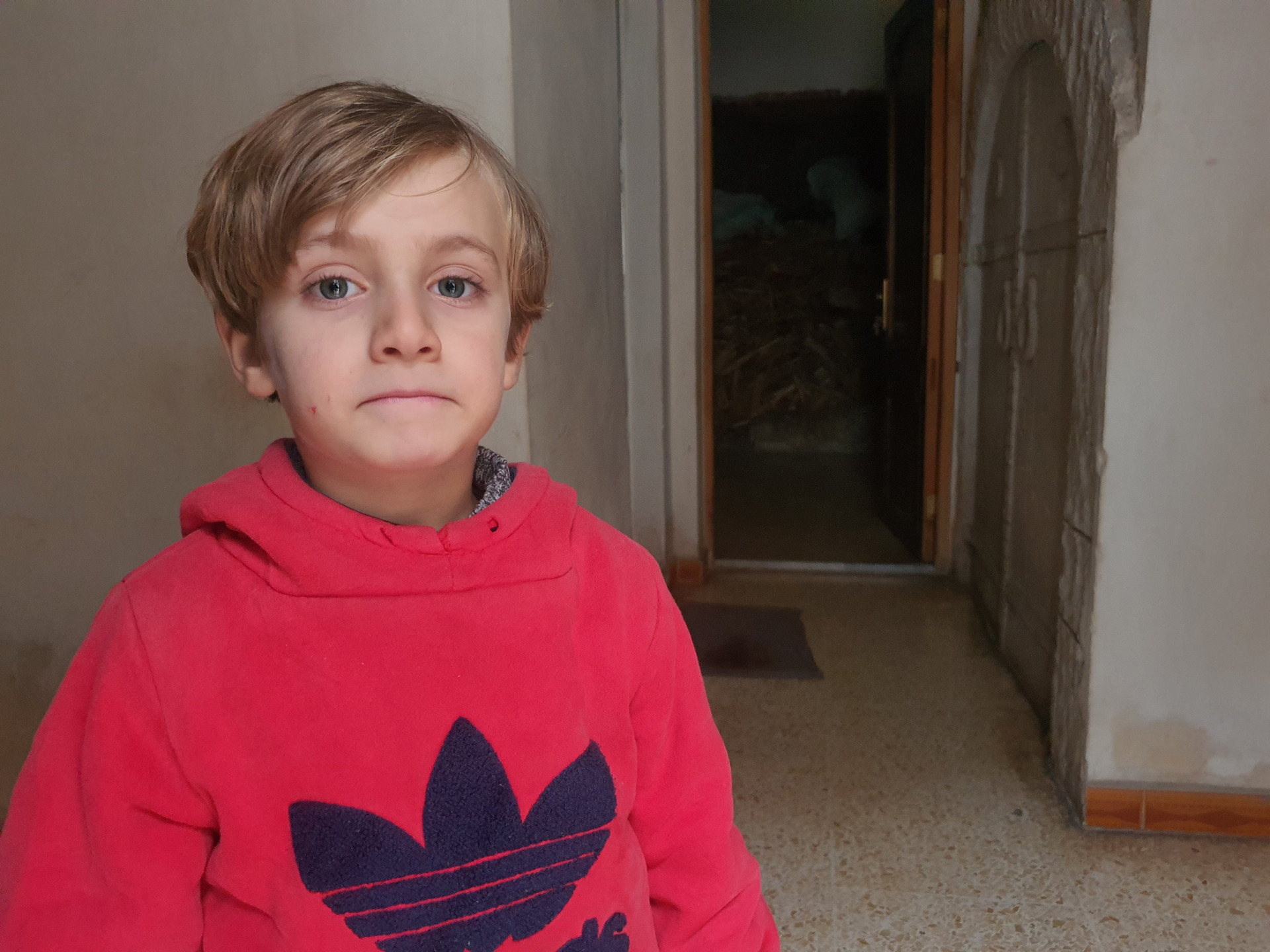 Hassan suffers from congenital diplopia for which he needs surgery.