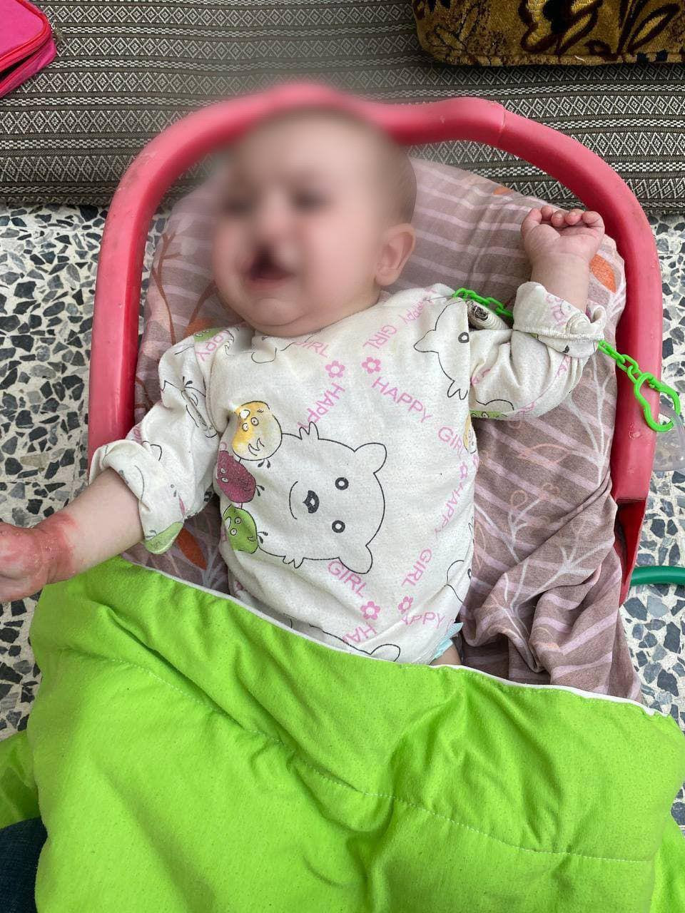 Yahia suffers from cleft palate and needs urgent surgery