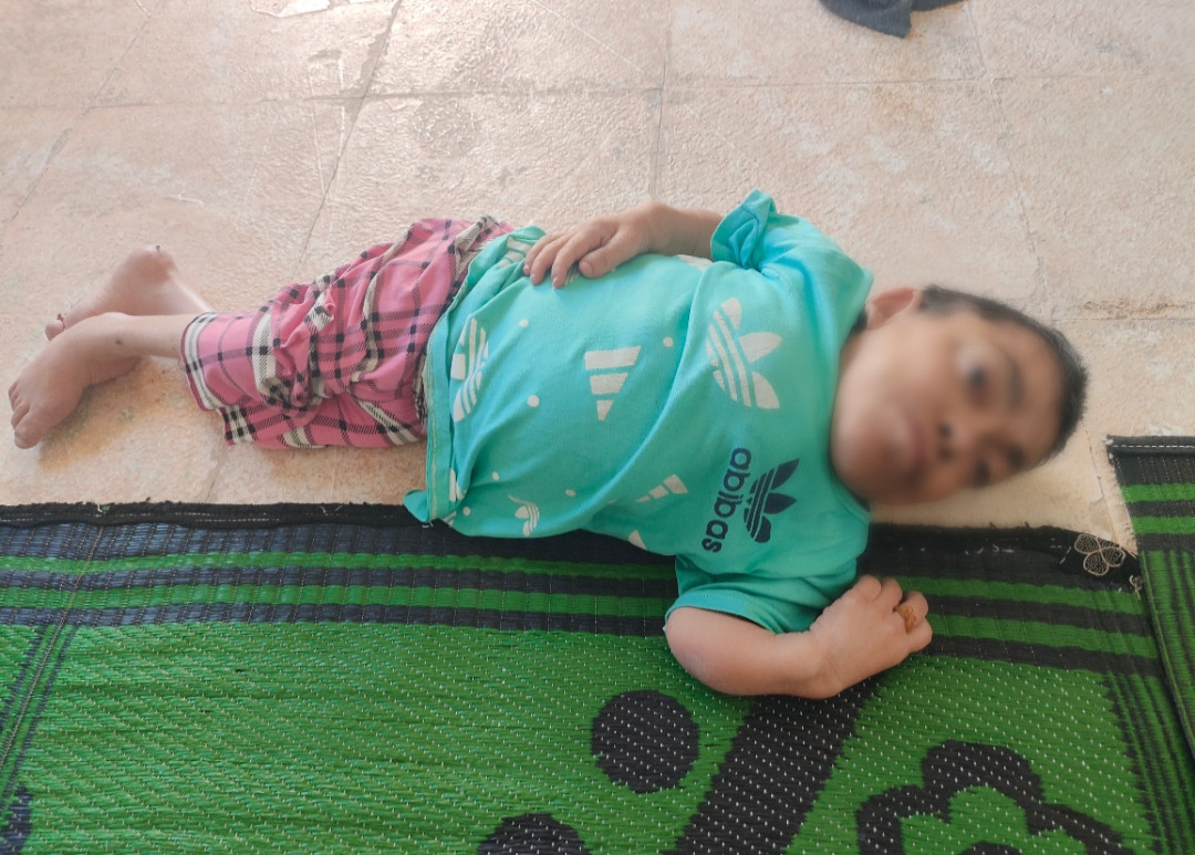 ابنتين بضمورٍ دماغي