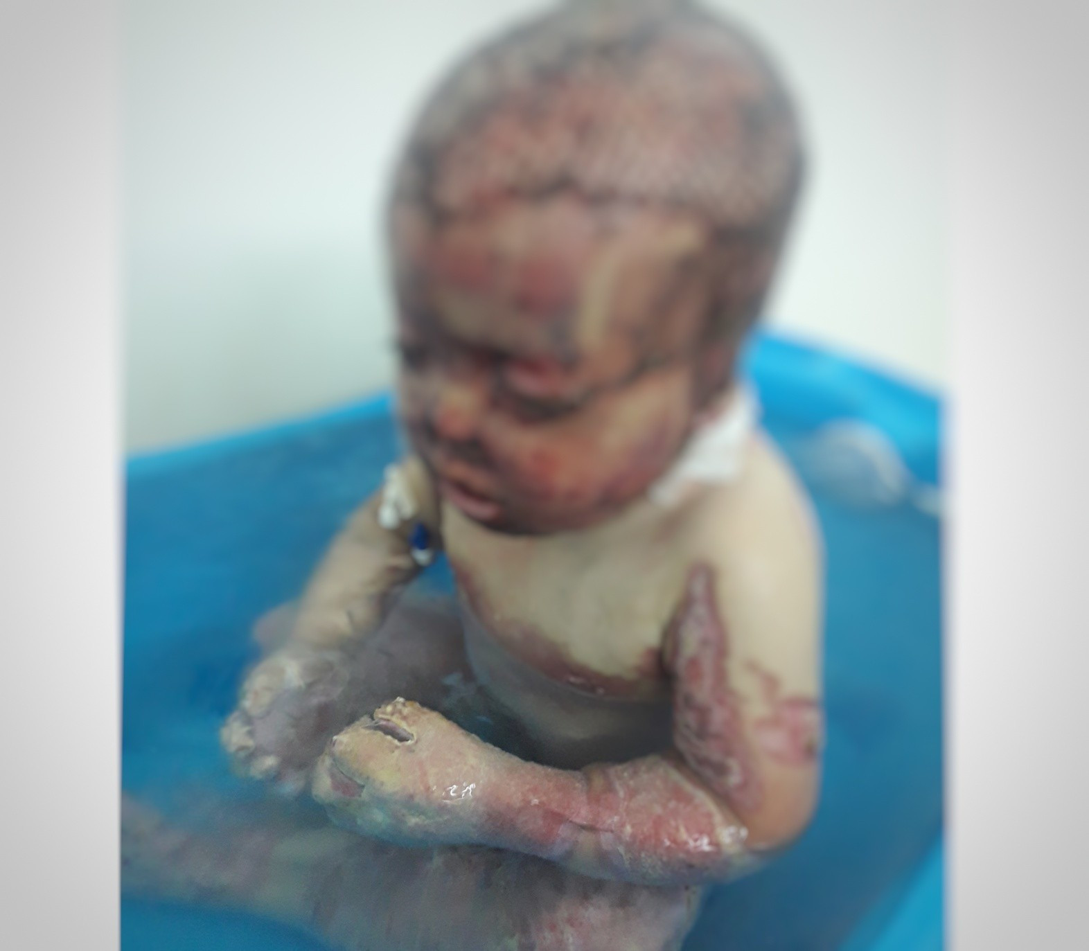 A child suffered fourth-degree burns!