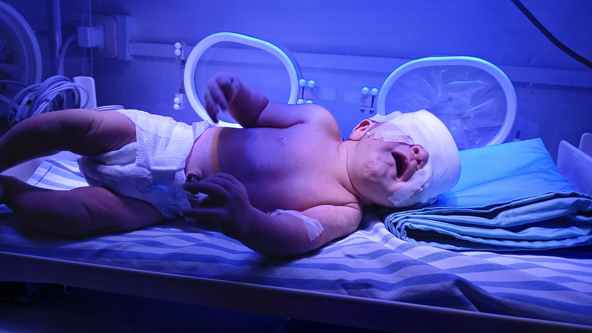 newborn suffers from jaundice