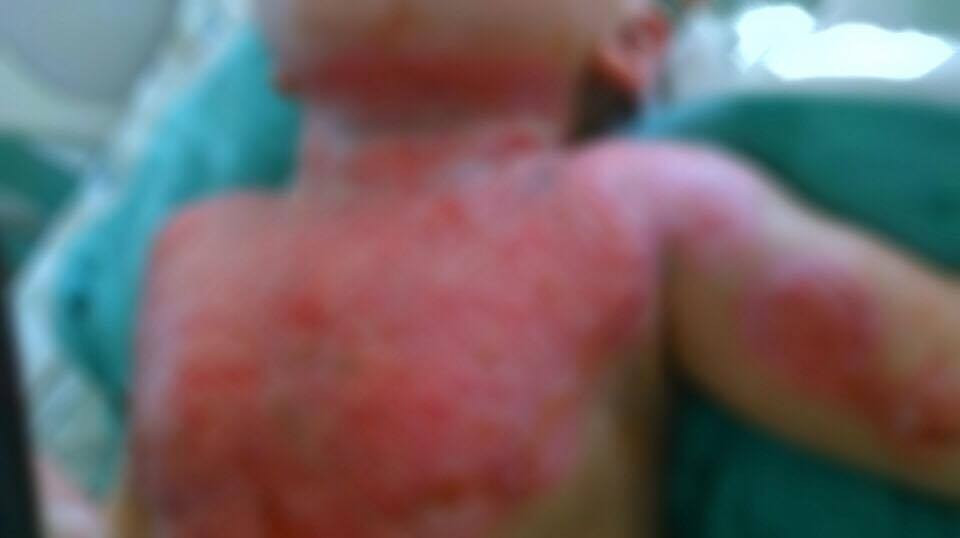 Sundus, small baby subjected to burns