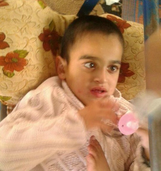 A child suffers from cerebral atrophy