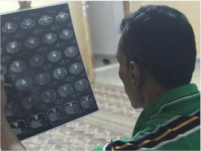 A man with kidney stones
