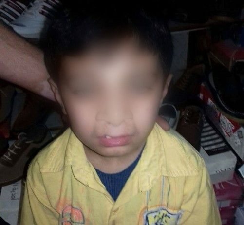 A child with congenital malformation