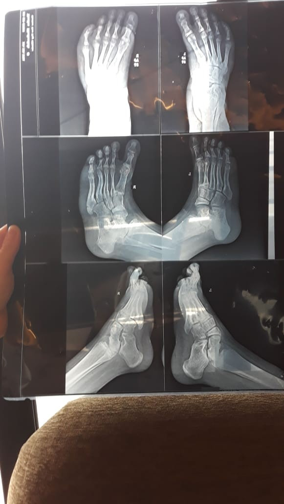 Club foot surgical correction