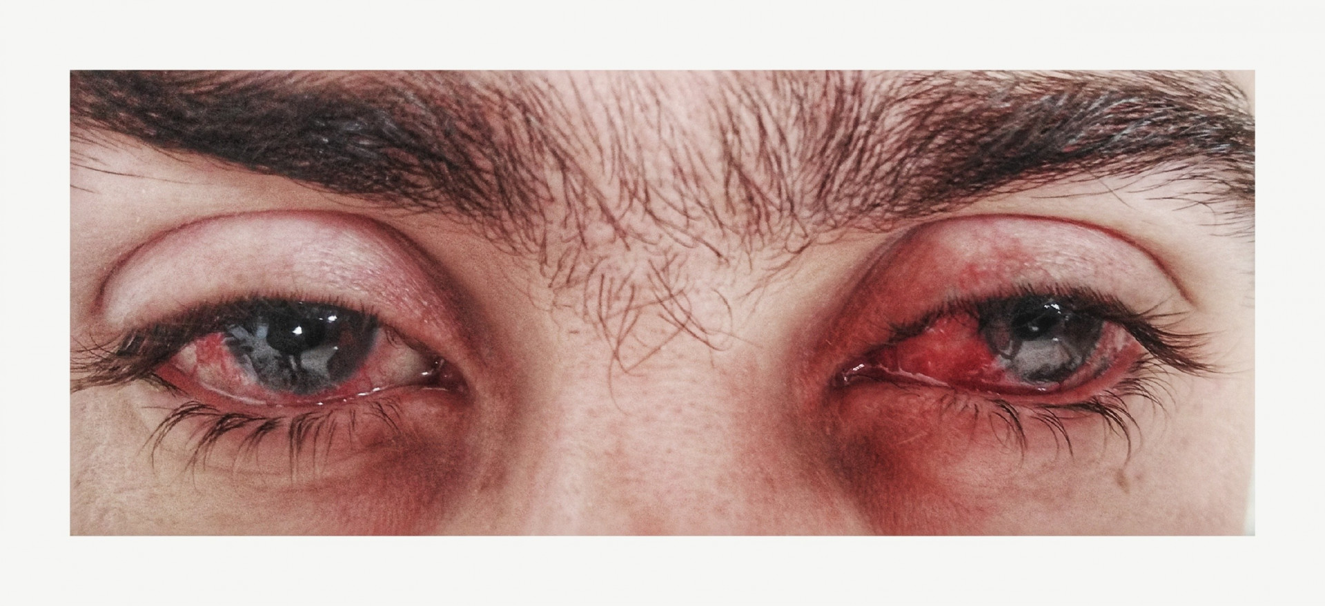 A young man needs eye surgery