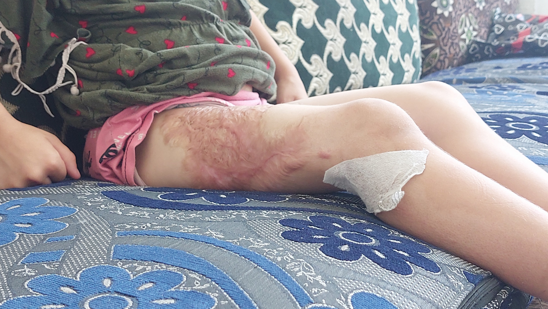 Sidra suffered severe burns and needs your help!