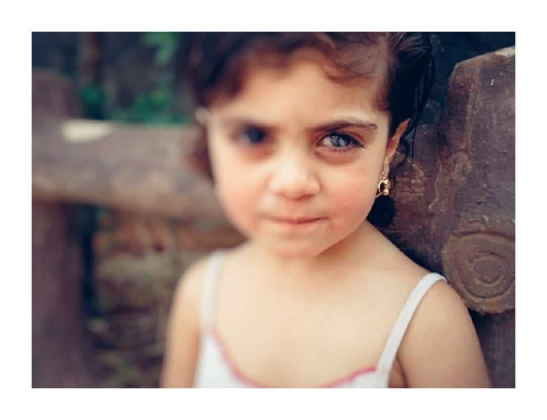 A girl child needs corneal transplant