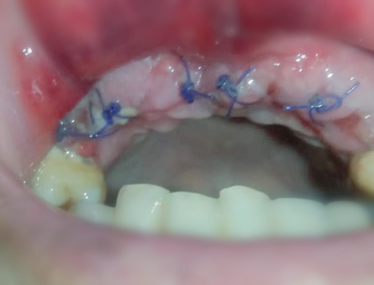 Faiha urgently needs dental implants