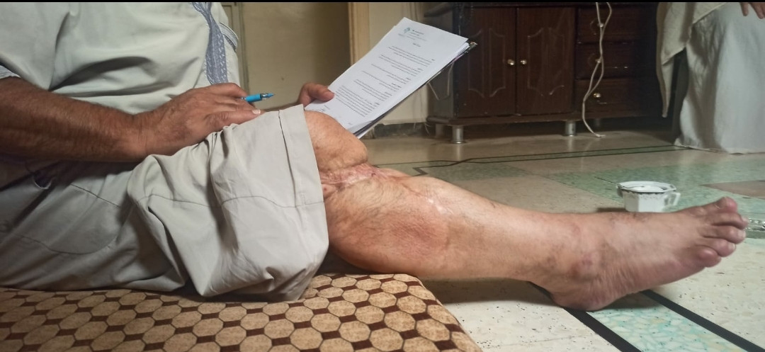 Abdul Razzaq had a painful accident, and his family was left without a breadwinner