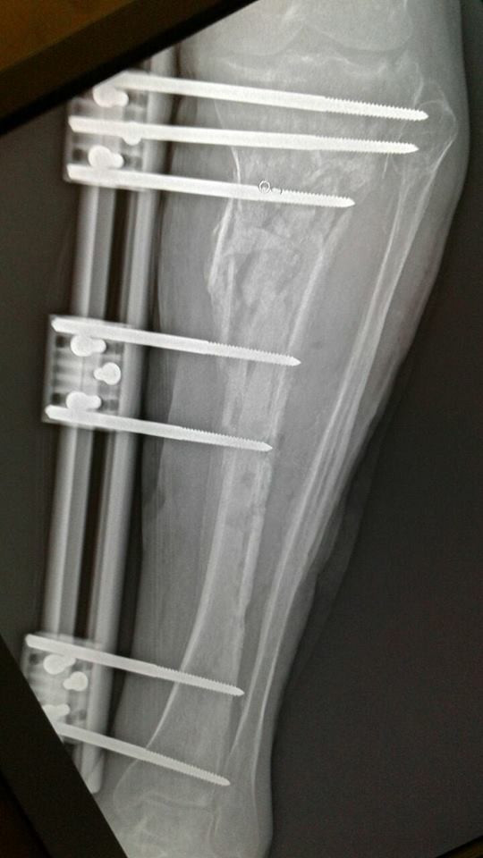 A refugee needs an operation in his foot