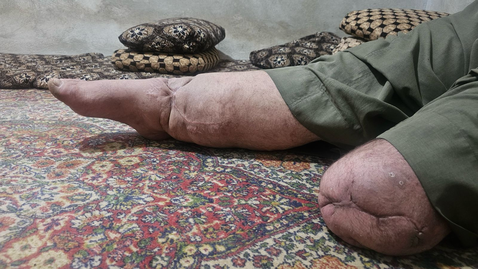He Lost a Leg, Now His Family Fights to Survive!