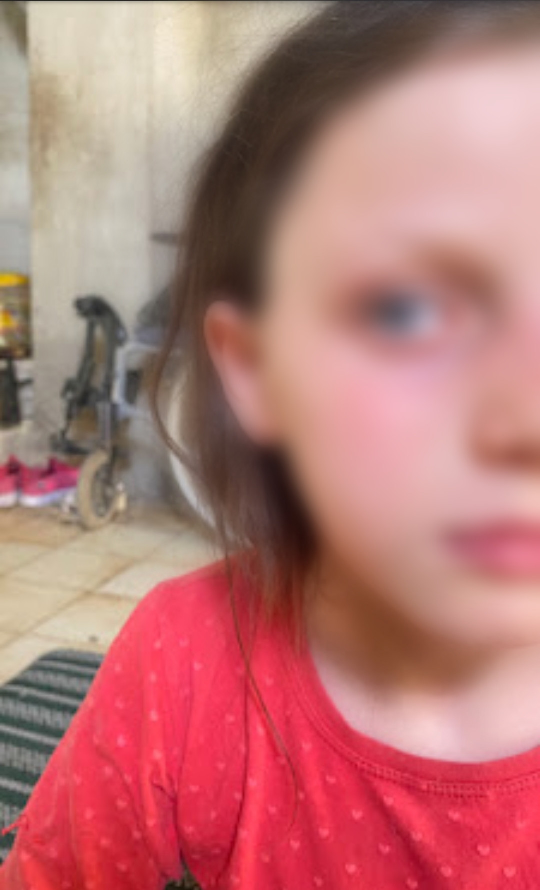 Ritaj, a child with eye injury who urgently needs a cornea transplant to prevent permanent blindness.