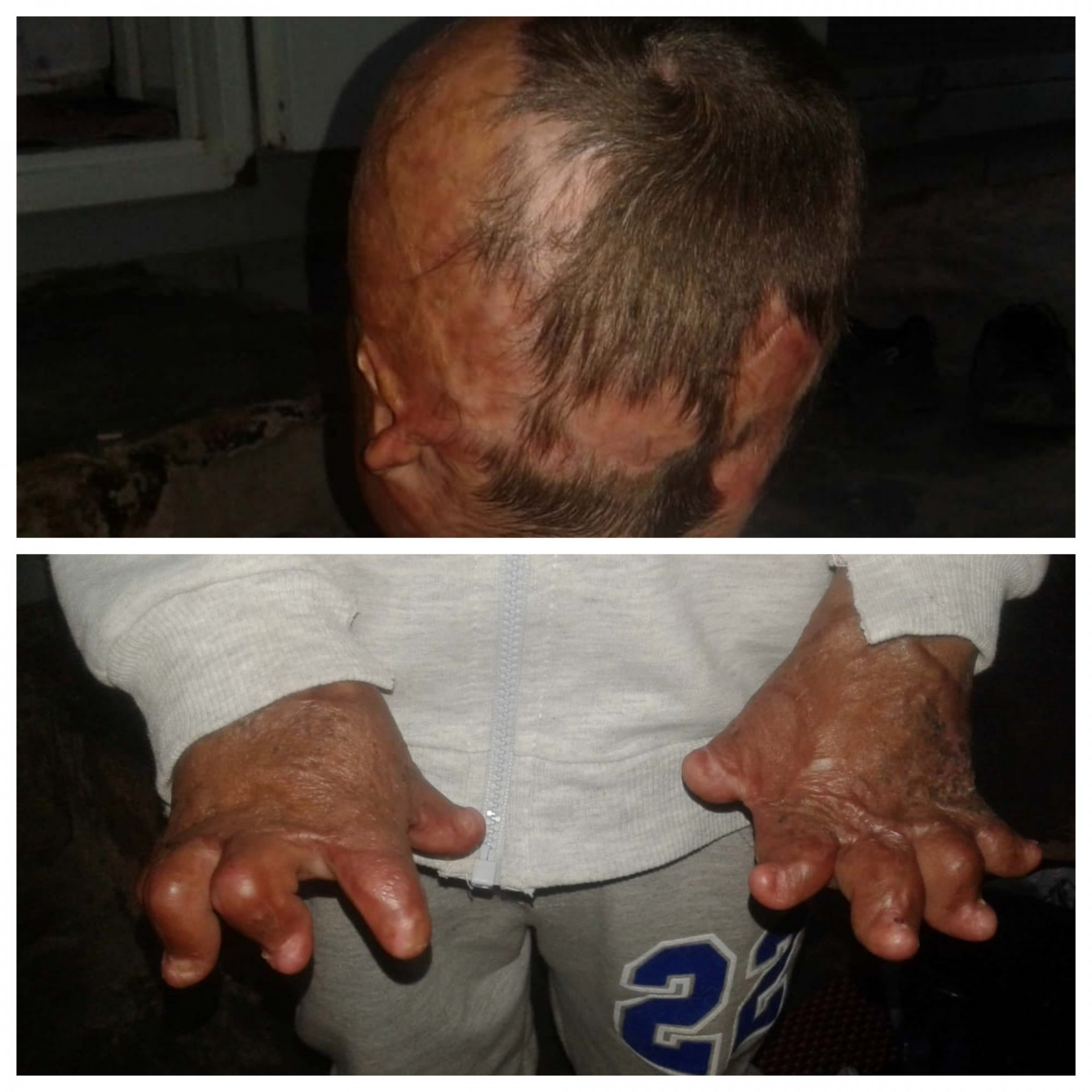 A child with burns and deformations