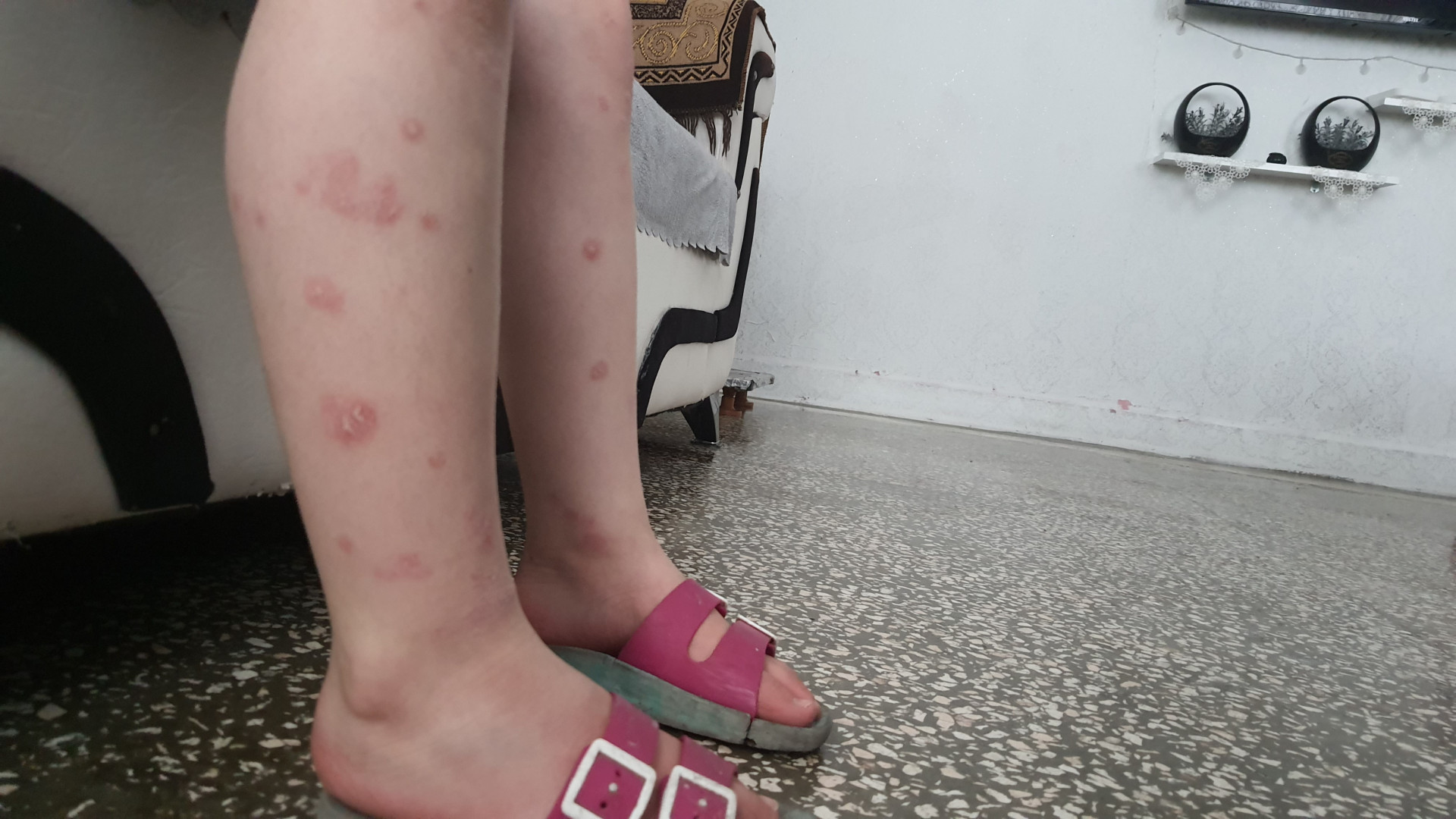 A seven-year-old girl with severe skin disease in need of treatment