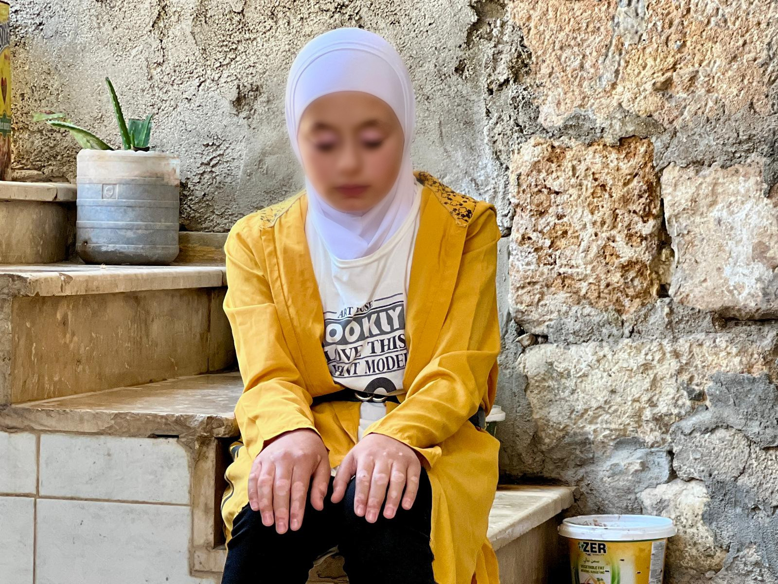 البهاق يثقل طفولة فاطمة