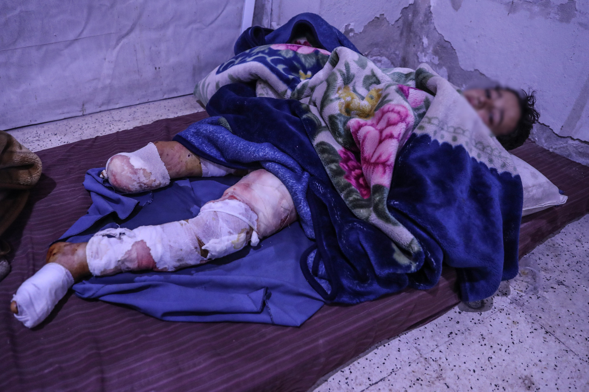A Child whose Leg is Amputated in Need of Medication Costs