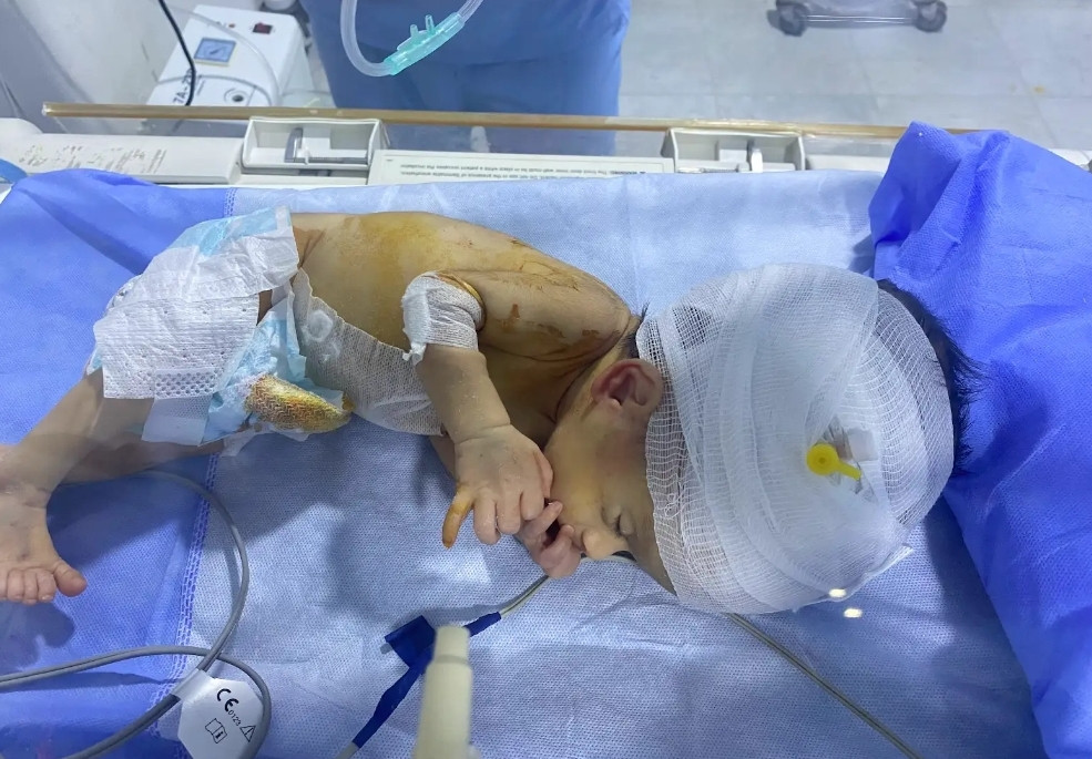 Rahaf was born with hydrocephalus and needs your help!