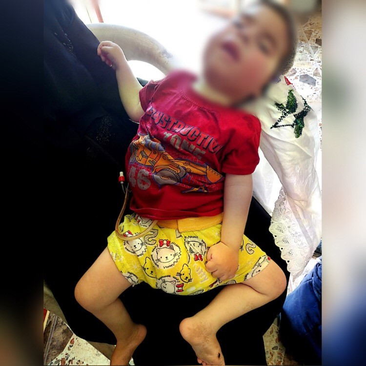 A boy with severe breath shortness needs medications