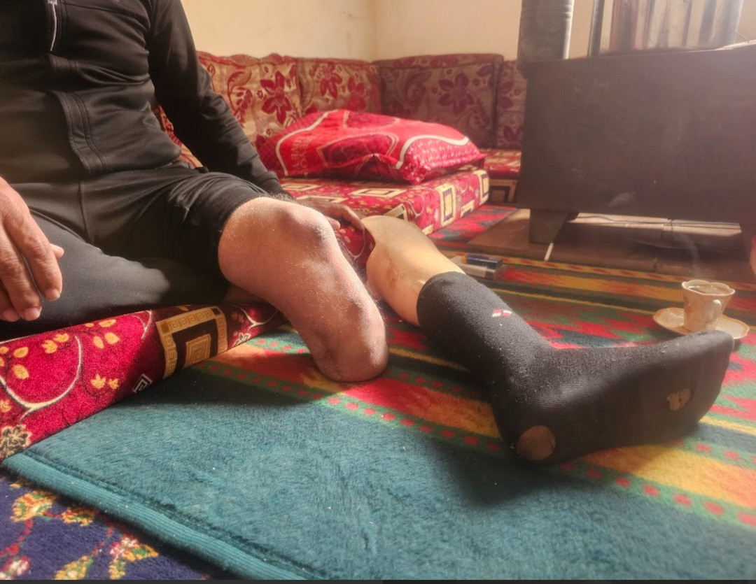 ساق مبتورة وبيت بلا أبواب