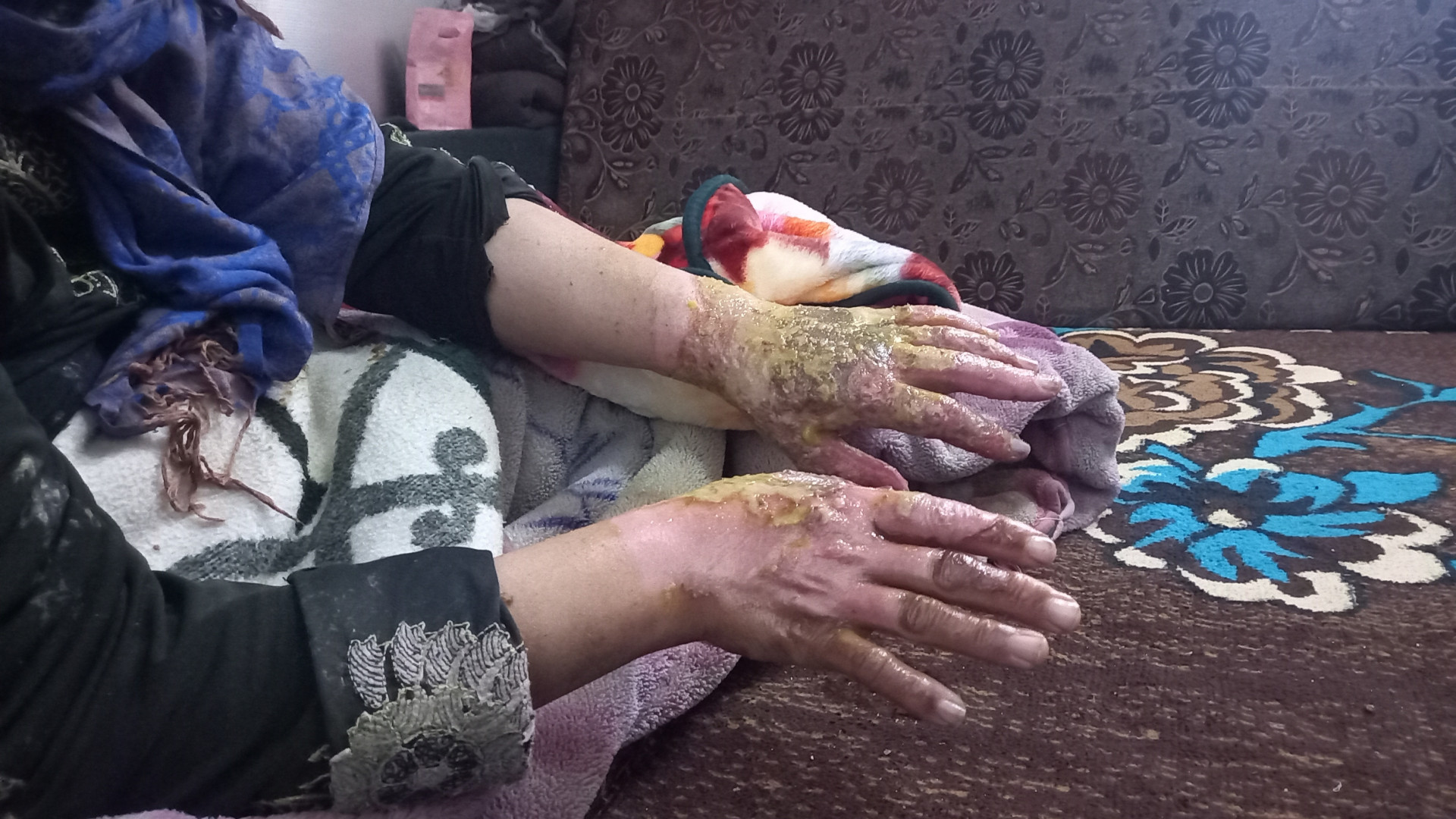 An electric fire burned her body and she needs your help!