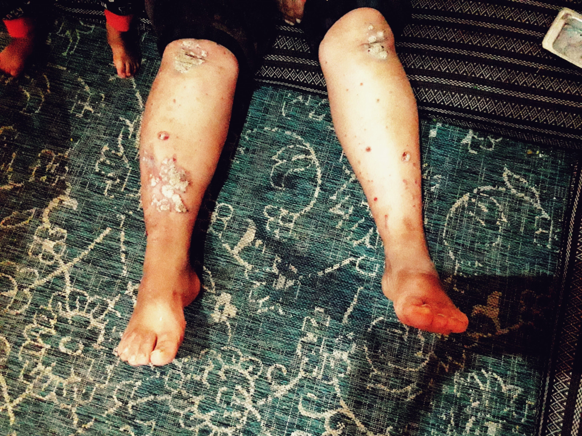 A father and his son suffer from Psoriasis!