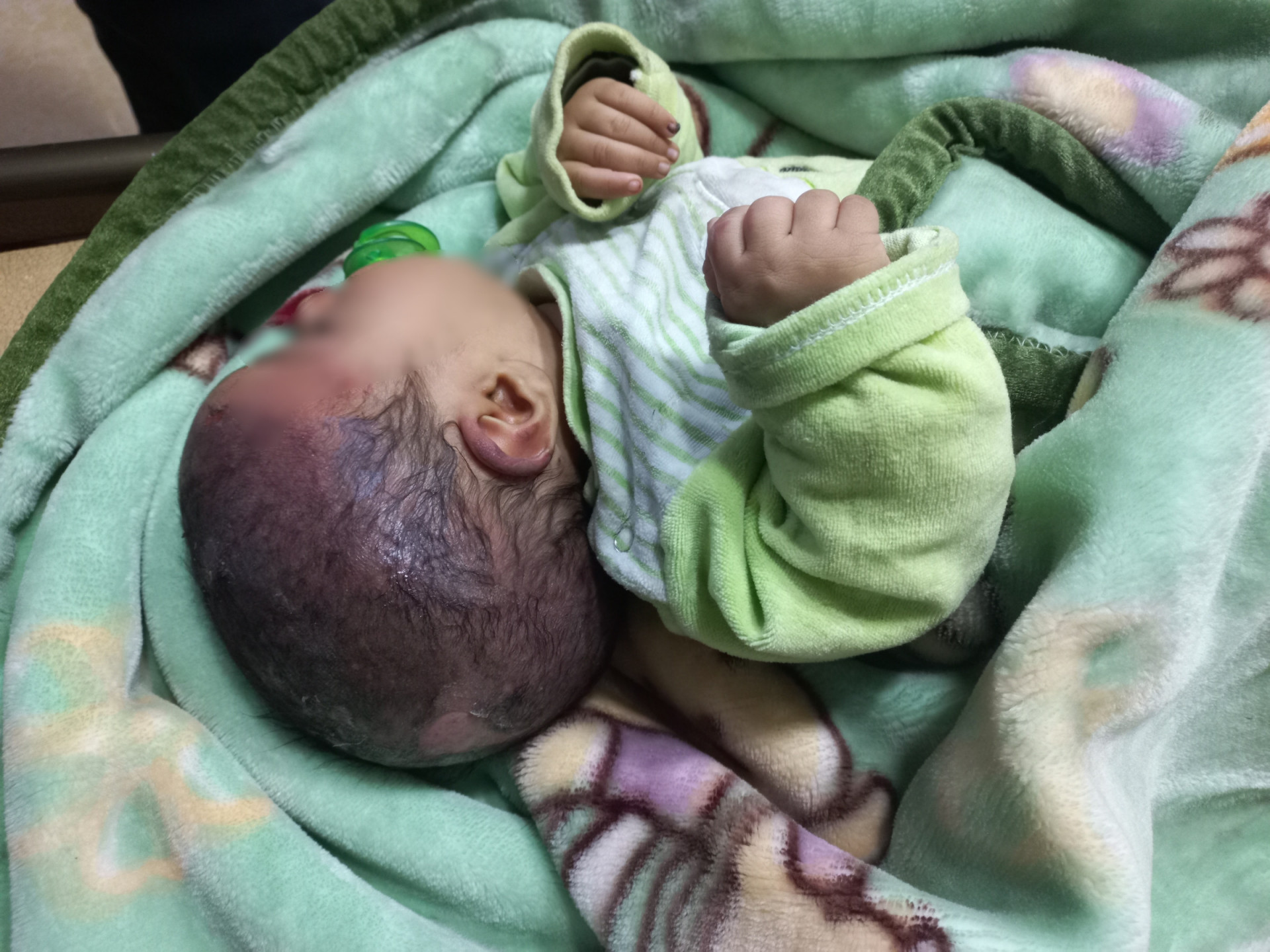 Abdulghafour is a newborn with severe head burns, needs treatment