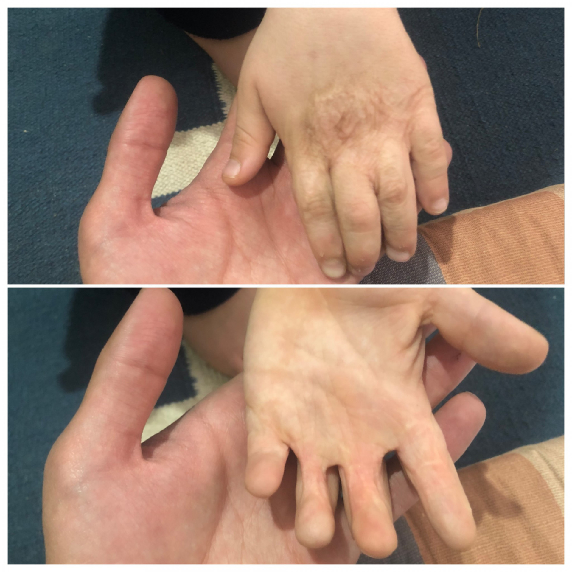 He got burns caused deformations of arms.