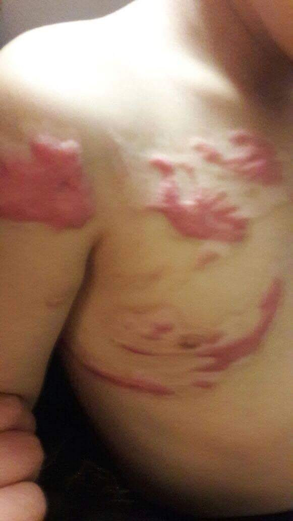 A refugee suffering from burns in the facial and chest area