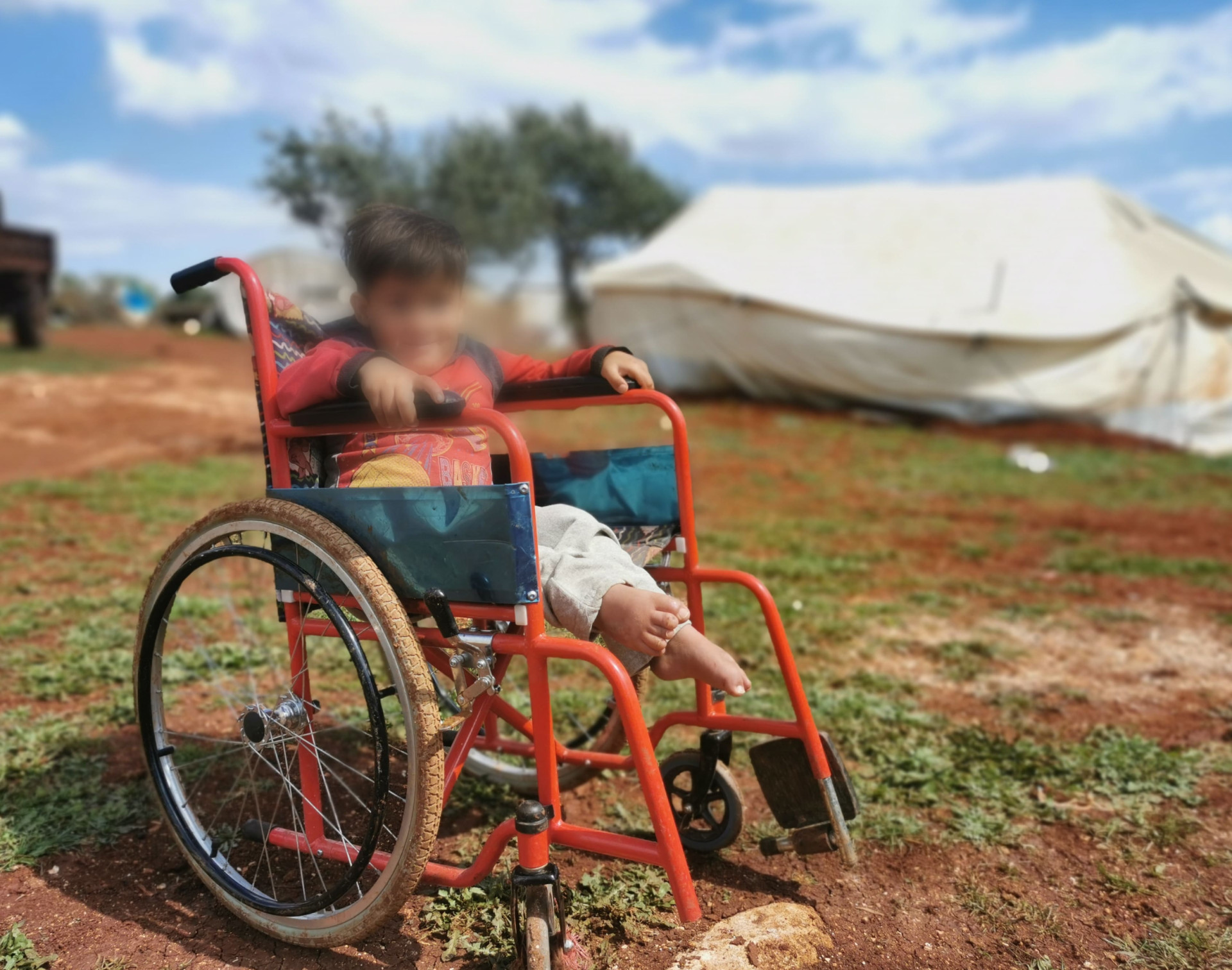 Ata suffers from hydrocephalus and in need for cerebral shunt