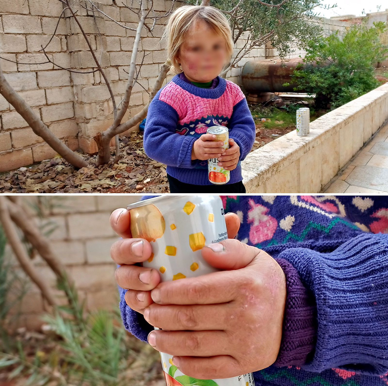 A child suffering form burn injuries. Your support is her only hope to heal her scars with laser treatment