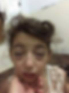 A child with eye issues