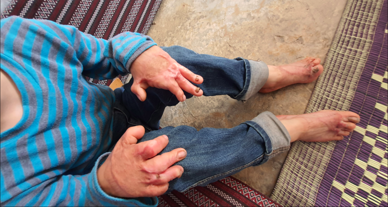 A child was severely deformed due to a tent fire!