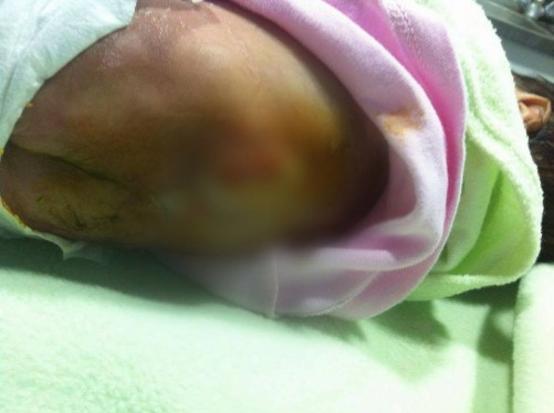 Surgery for an Infant