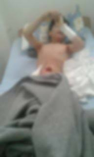 Child suffering from intestinal rupture