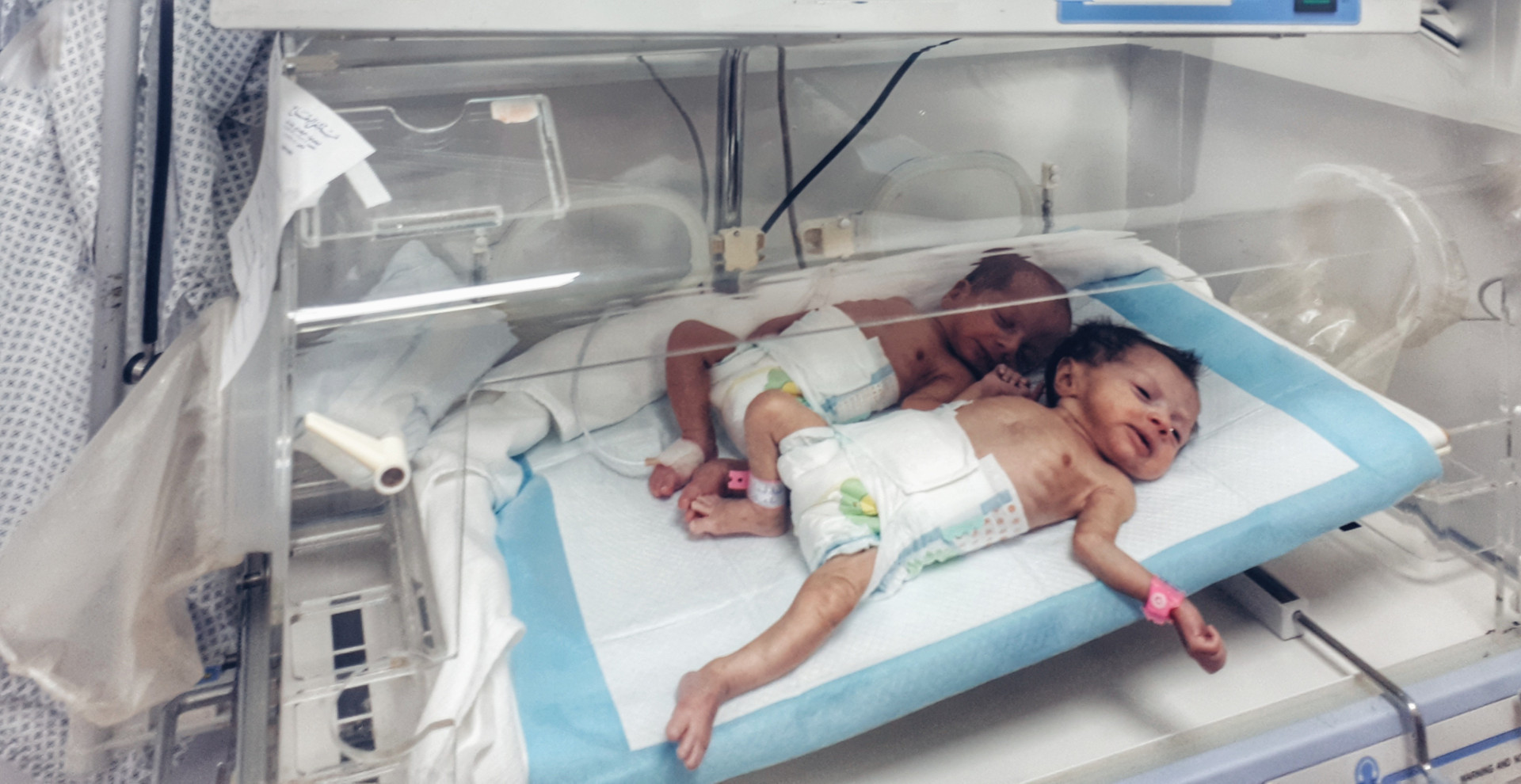 A twin with early delivery