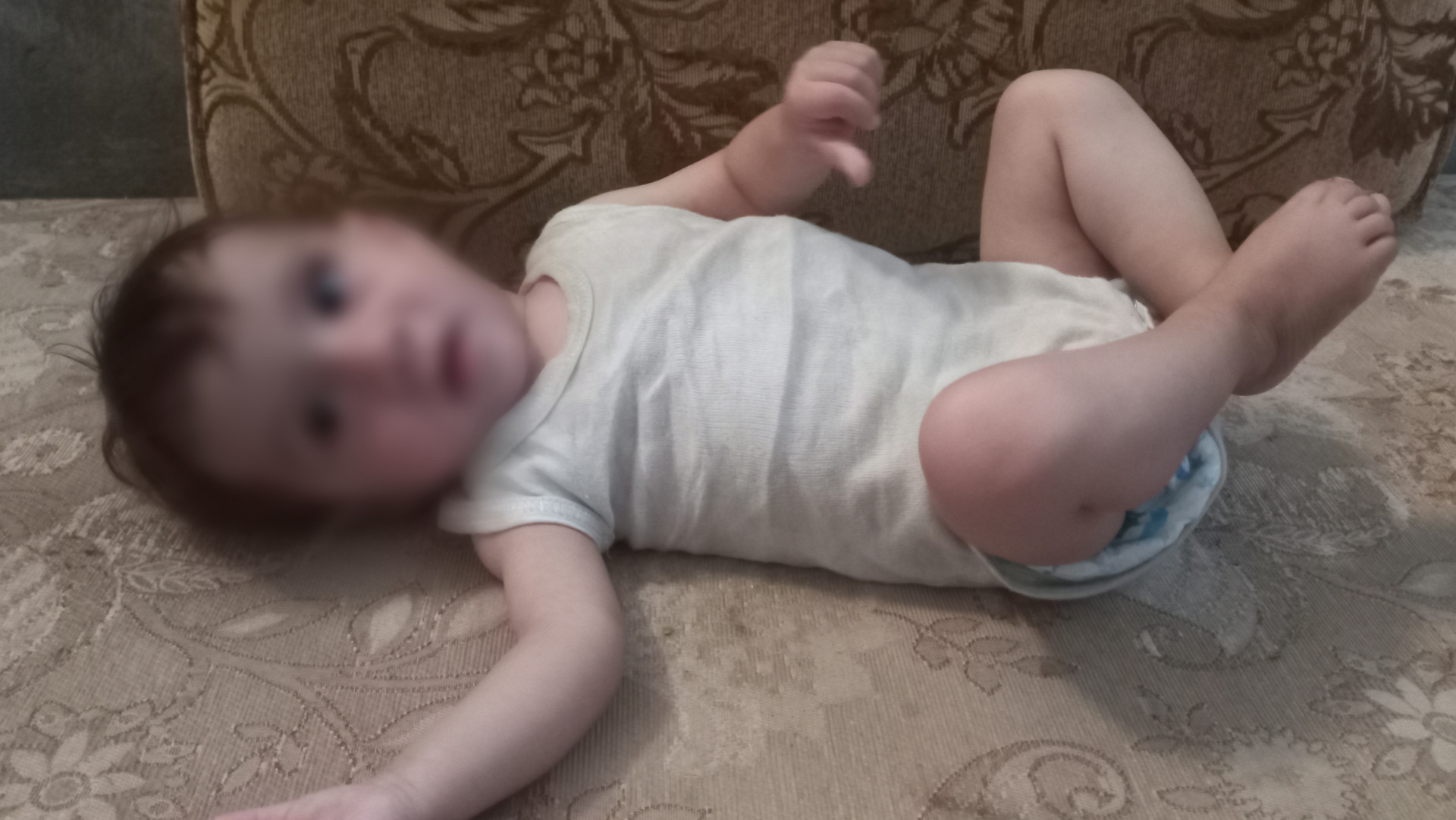 A little child with hydrocephalus needs urgent treatment.