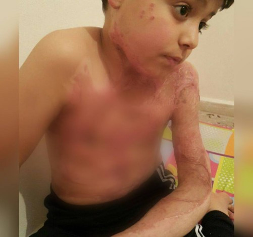 Medical Assistance for a Burned Child