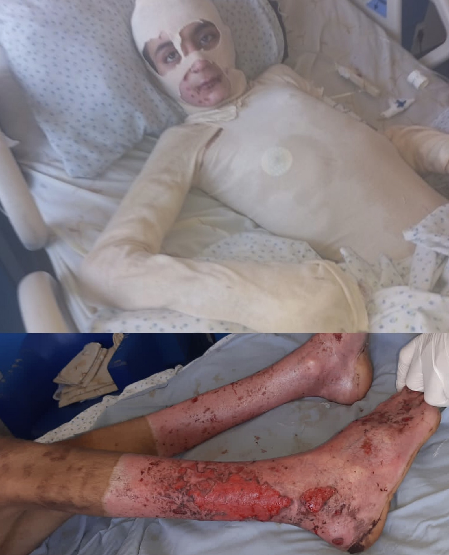 Hassan needs your donations to alleviate the pain of his burns.