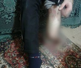a refugeen in need of a Prosthesis