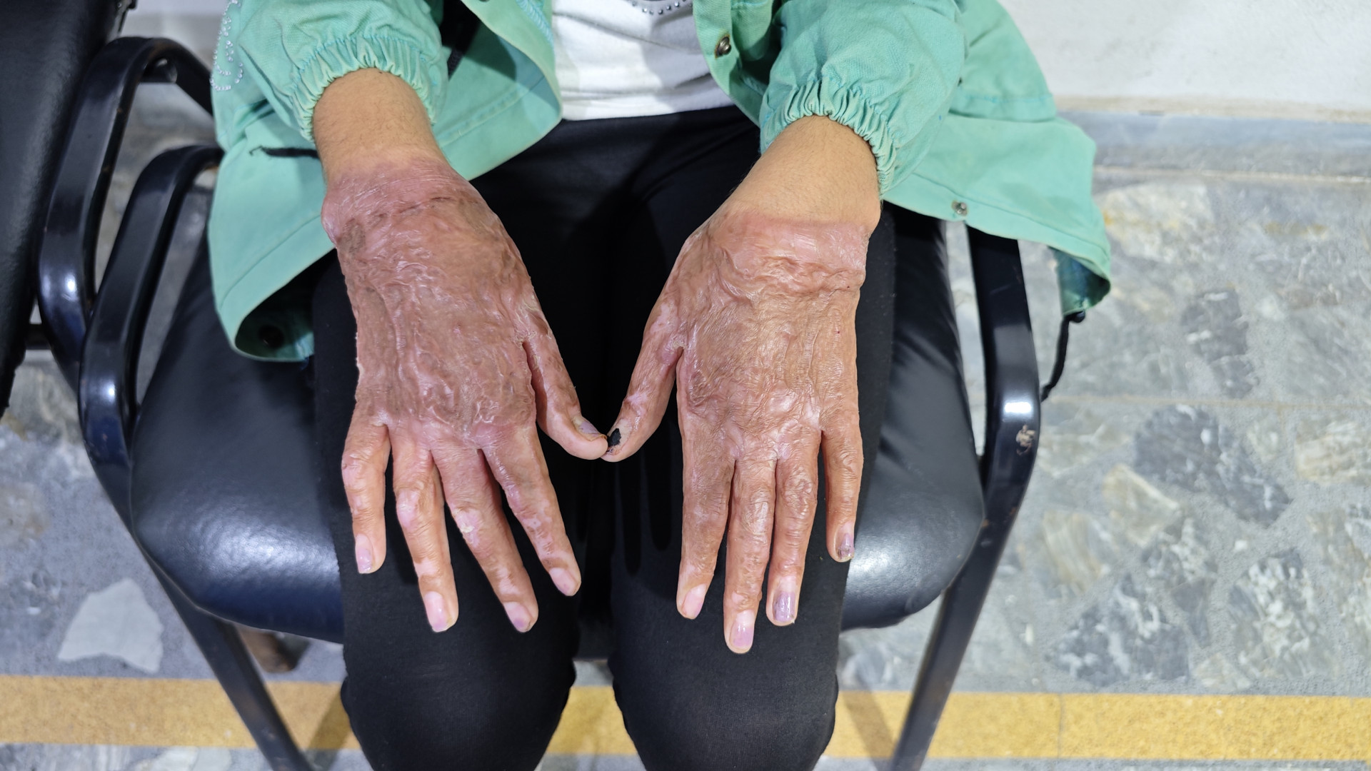 Suffering From Burns and Disfigurements Can Leave a Deep Psychological Impact on The Affected Individual!