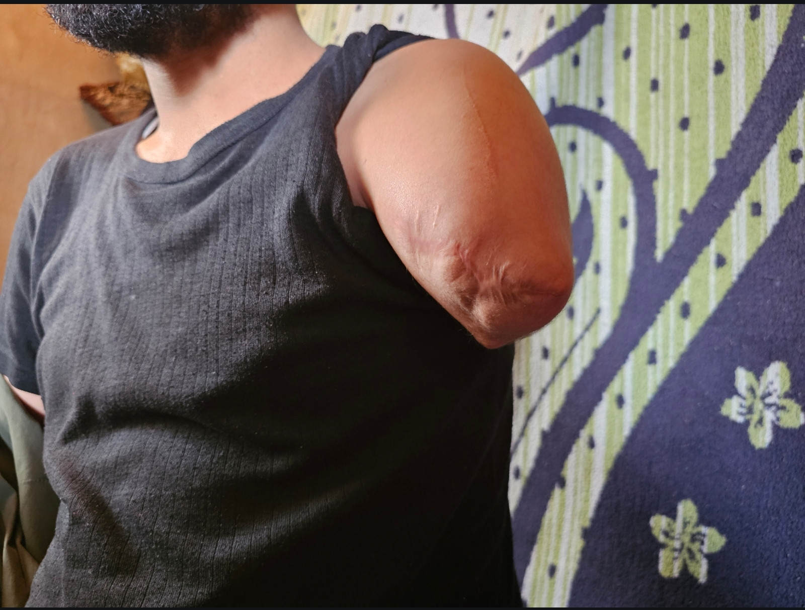An Injury That Stopped Hassan from Working