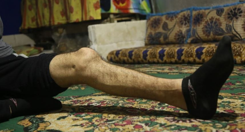 Leg fire injury